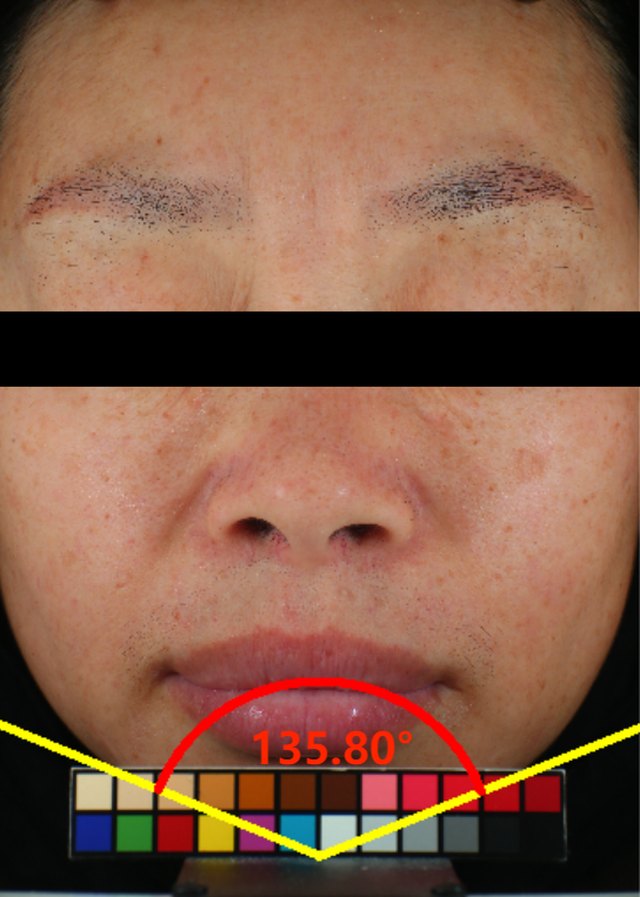 Firming before clinical image on day 0