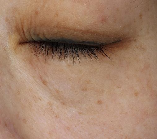 Dark circles before clinical image on day 0