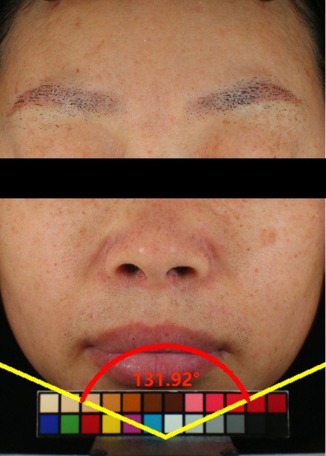Firming after clinical image on day 28