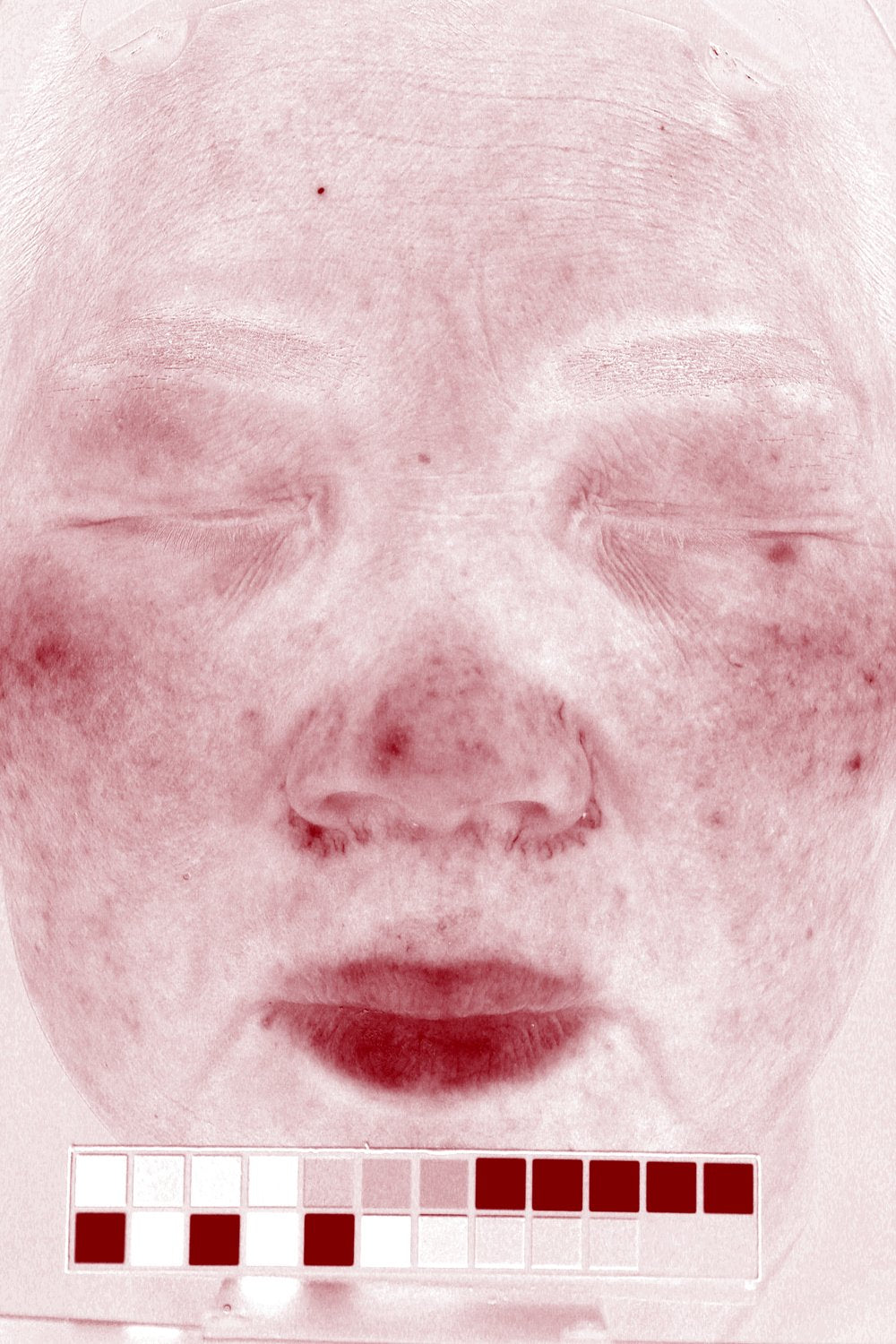 Participant 1 after VISIA-CR redness map on day 28
