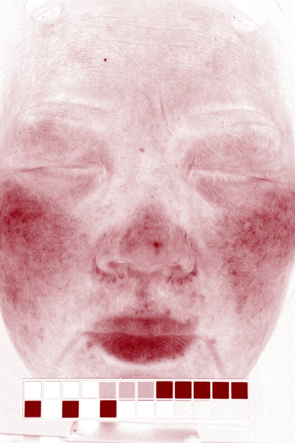 Participant 1 before VISIA-CR redness map on day 0