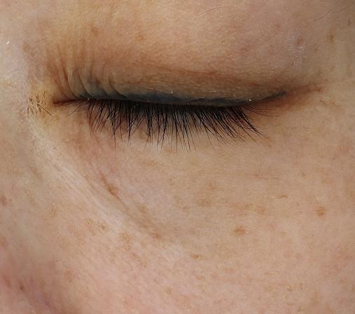 Dark circles after clinical image on day 28